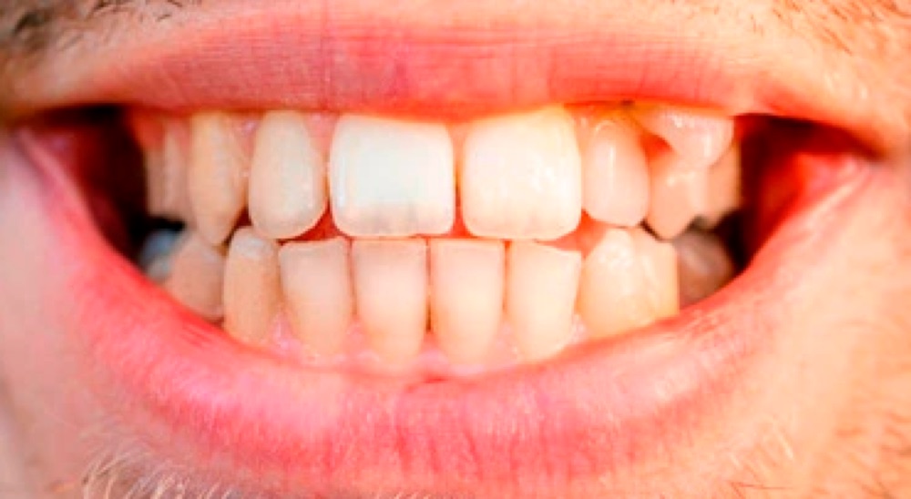 Antes: aparelho dentário