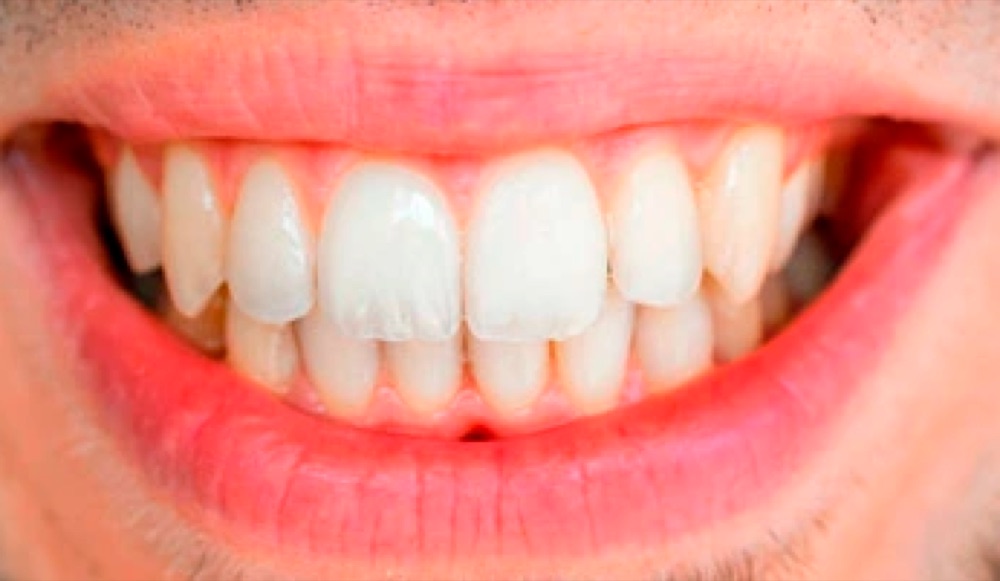 Depois: aparelho dentário