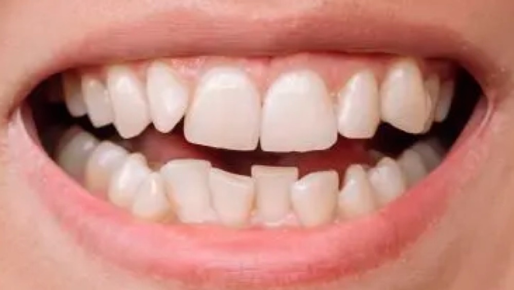 Antes: aparelho dentário
