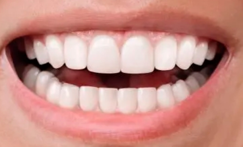 Depois: aparelho dentário