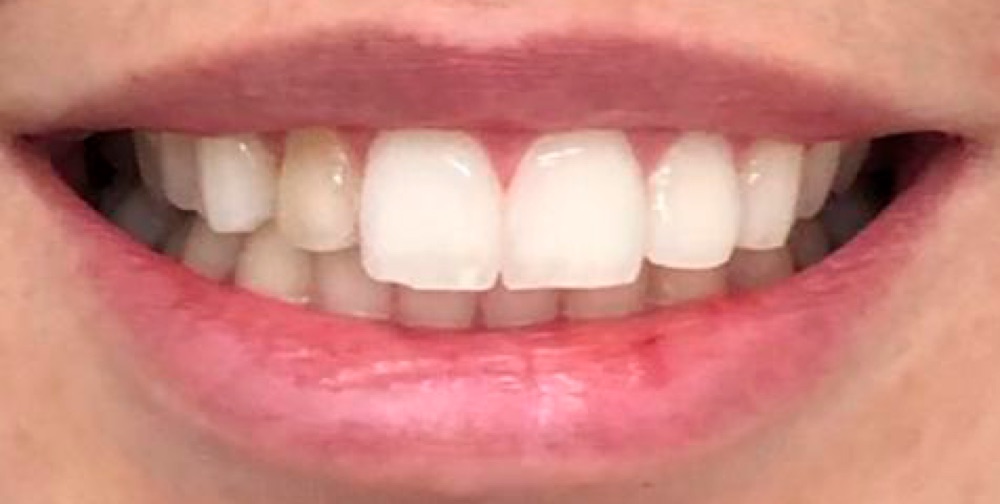 Antes: aparelho dentário