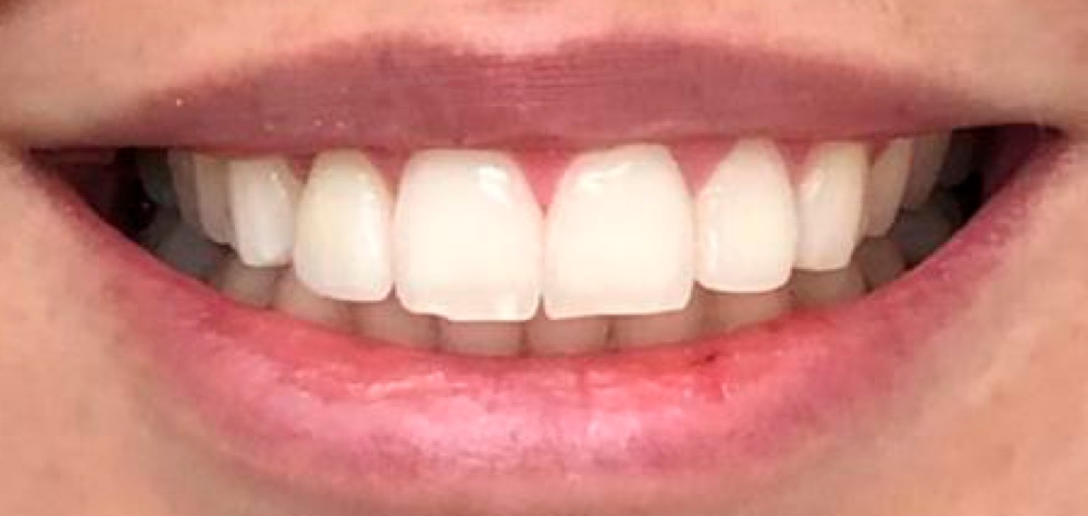 Depois: aparelho dentário