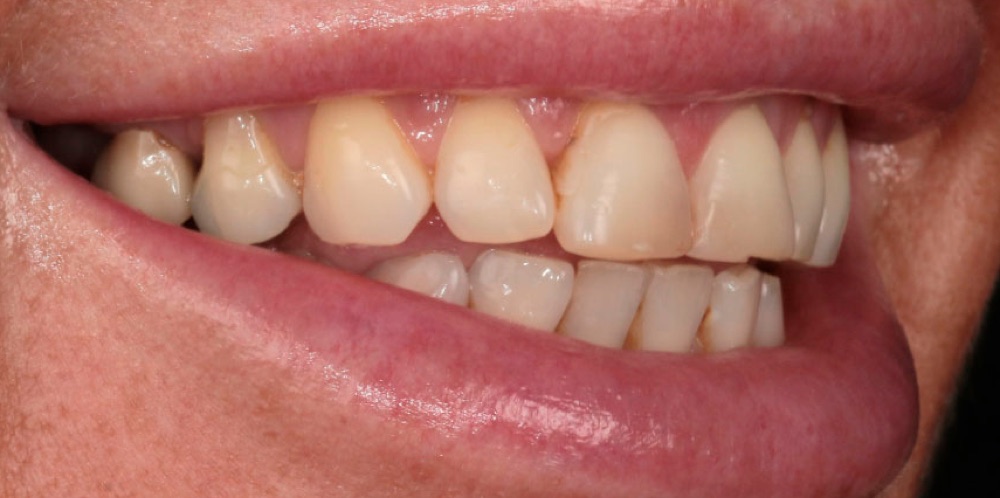 Antes: coroas dentárias