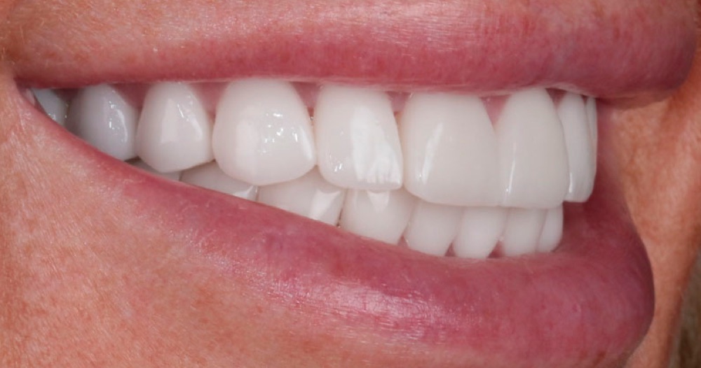 Depois: coroas dentárias