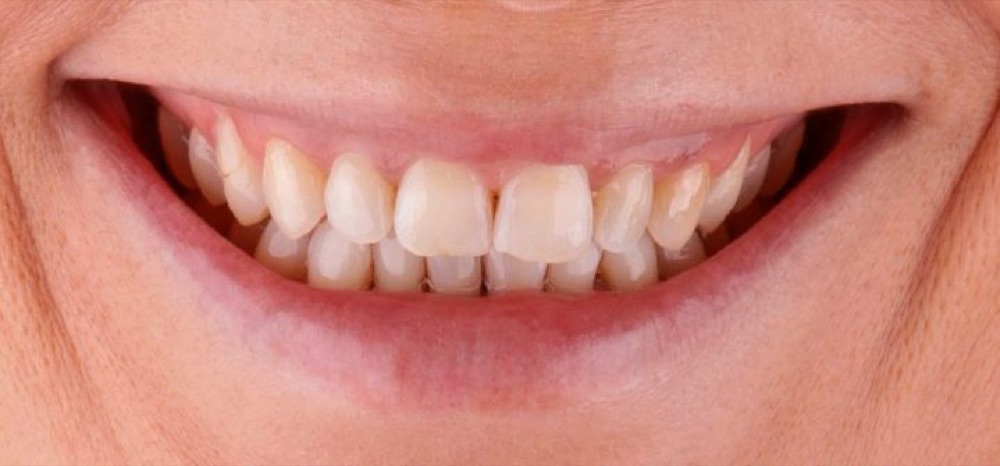 Antes: coroas dentárias