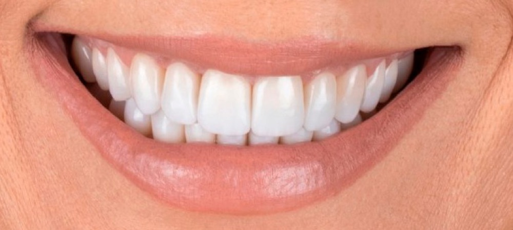 Depois: coroas dentárias