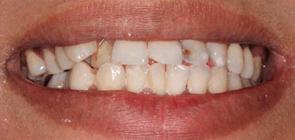Antes: reabilitação com coroas dentárias