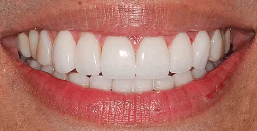 Depois: reabilitação com coroas dentárias