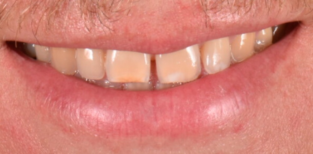 Antes: facetas dentárias