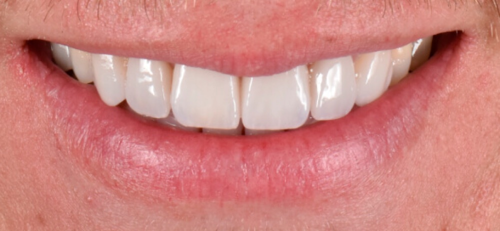 Depois: facetas dentárias
