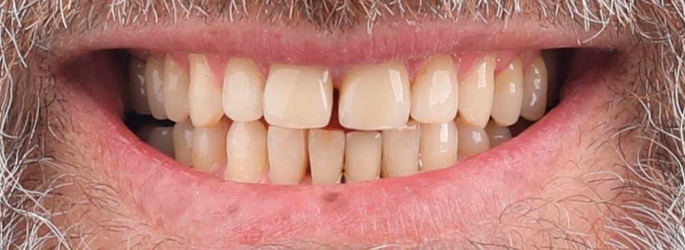 Antes: facetas dentárias