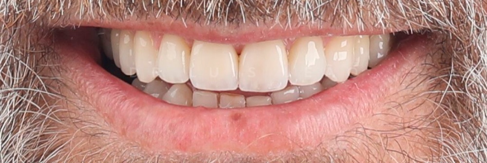 Depois: facetas dentárias