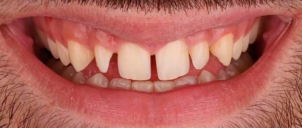 Antes: reabilitação estética completa