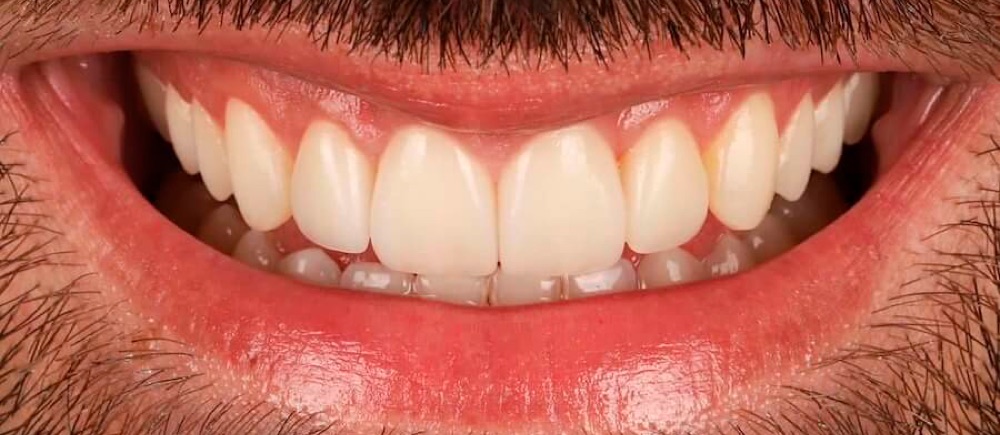 Depois: reabilitação estética completa