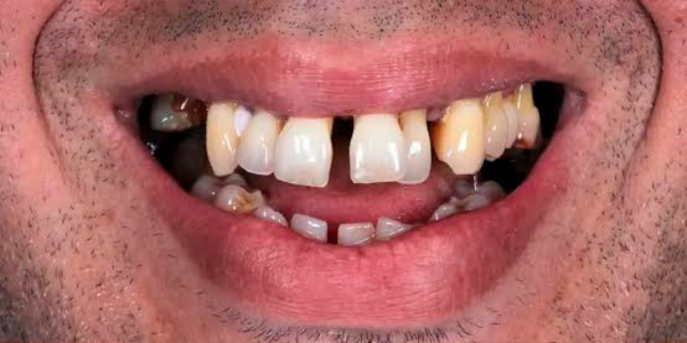 Antes: reabilitação com implantes em dia único