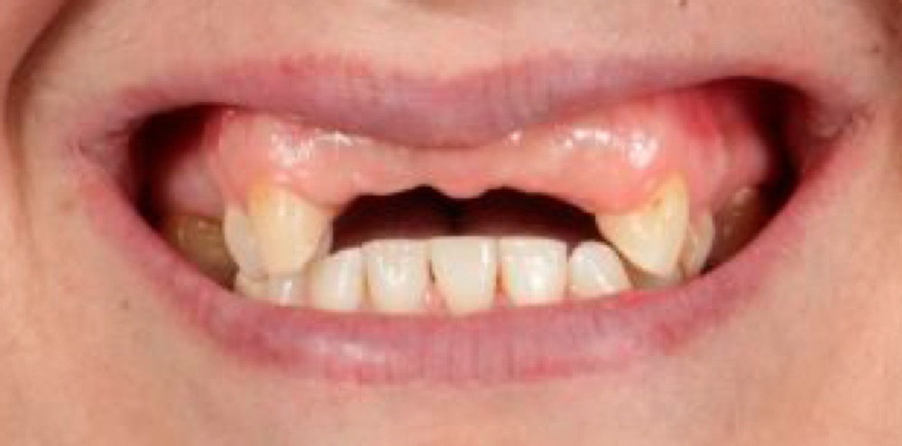 Antes: prótese dentária fixa