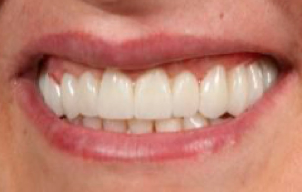 Depois: prótese dentária fixa