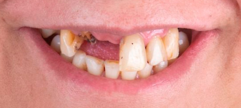 Antes: prótese dentária fixa