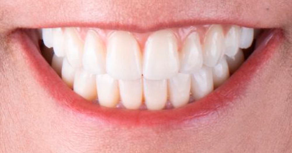 Depois: prótese dentária fixa