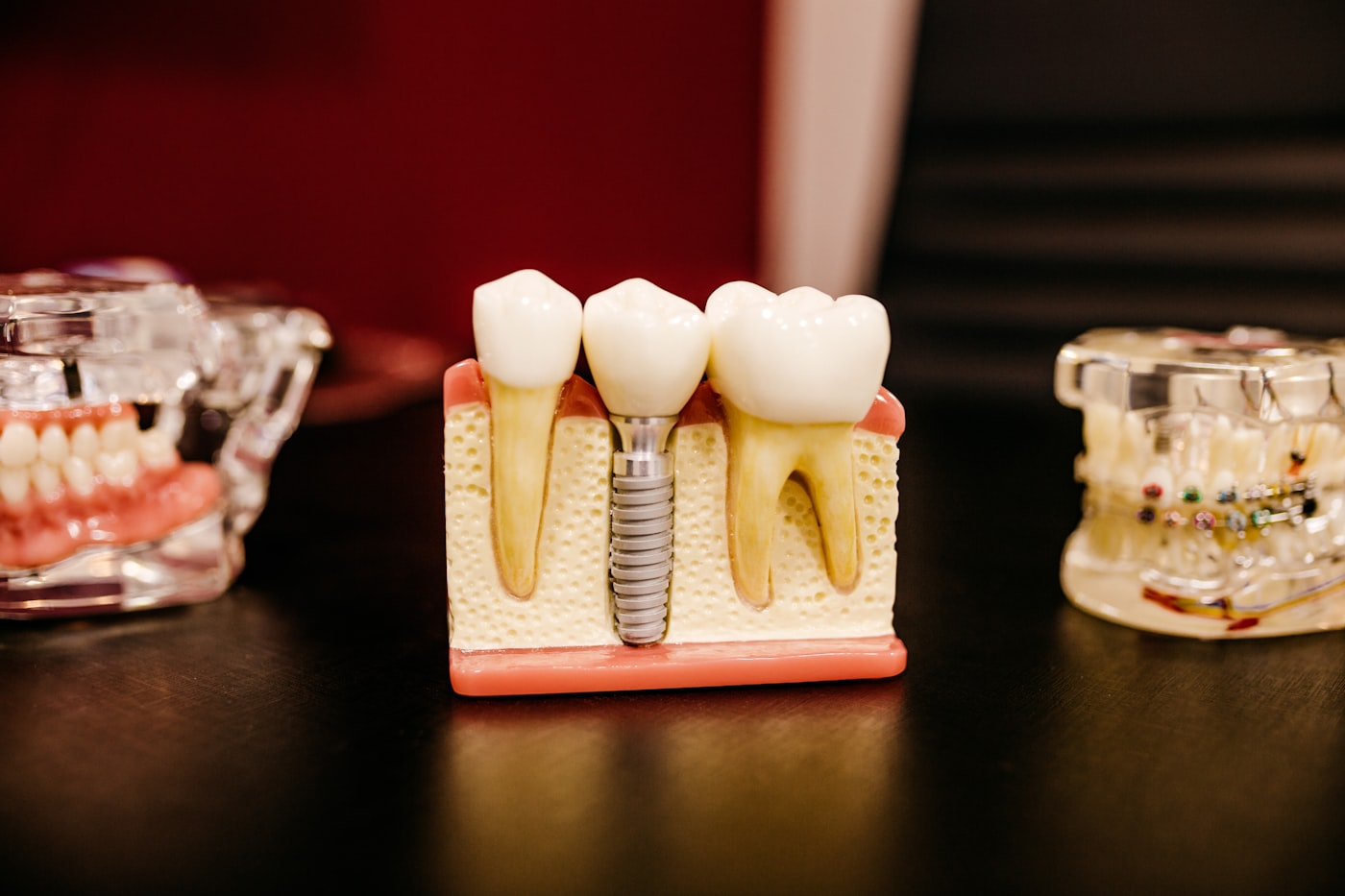 Implantes Dentários