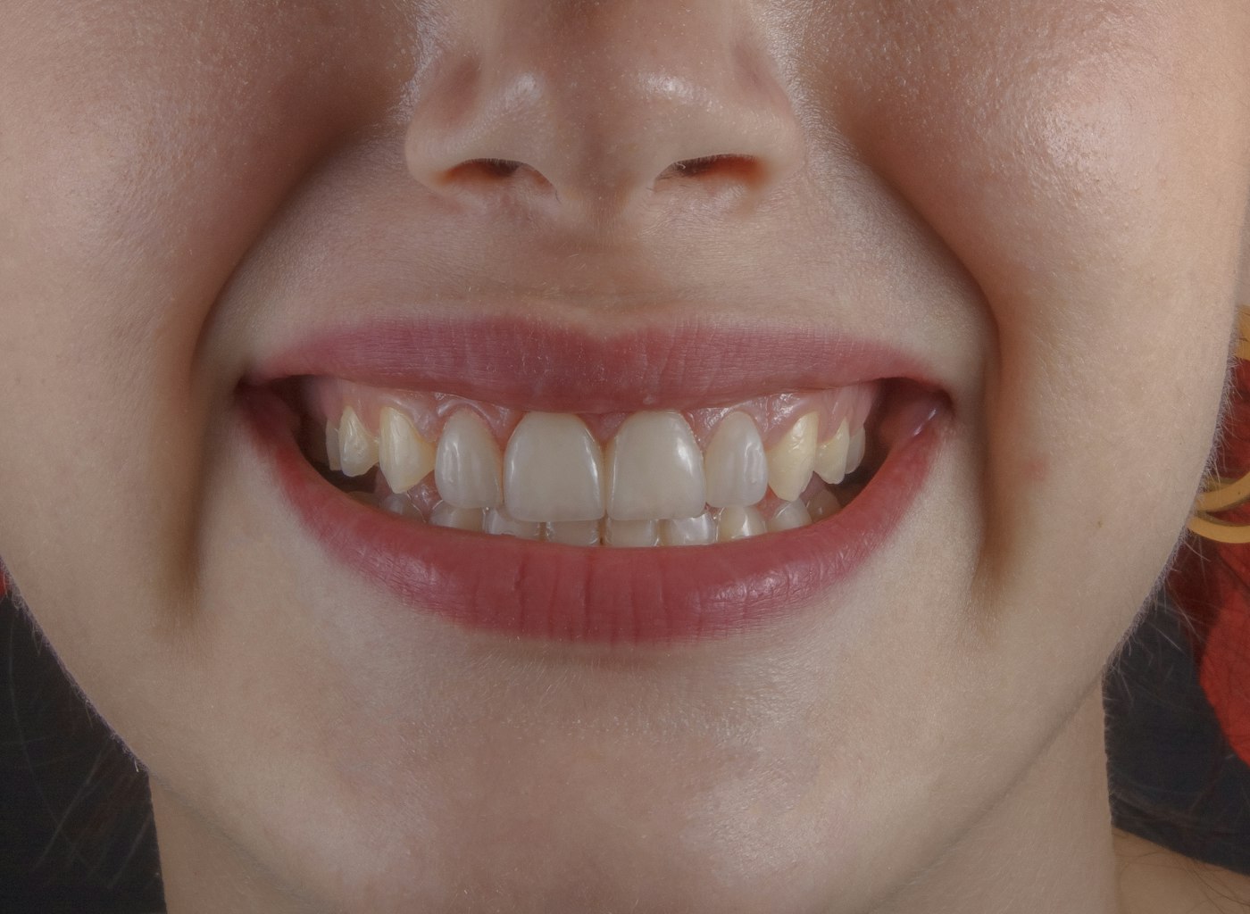Branqueamento Dentário