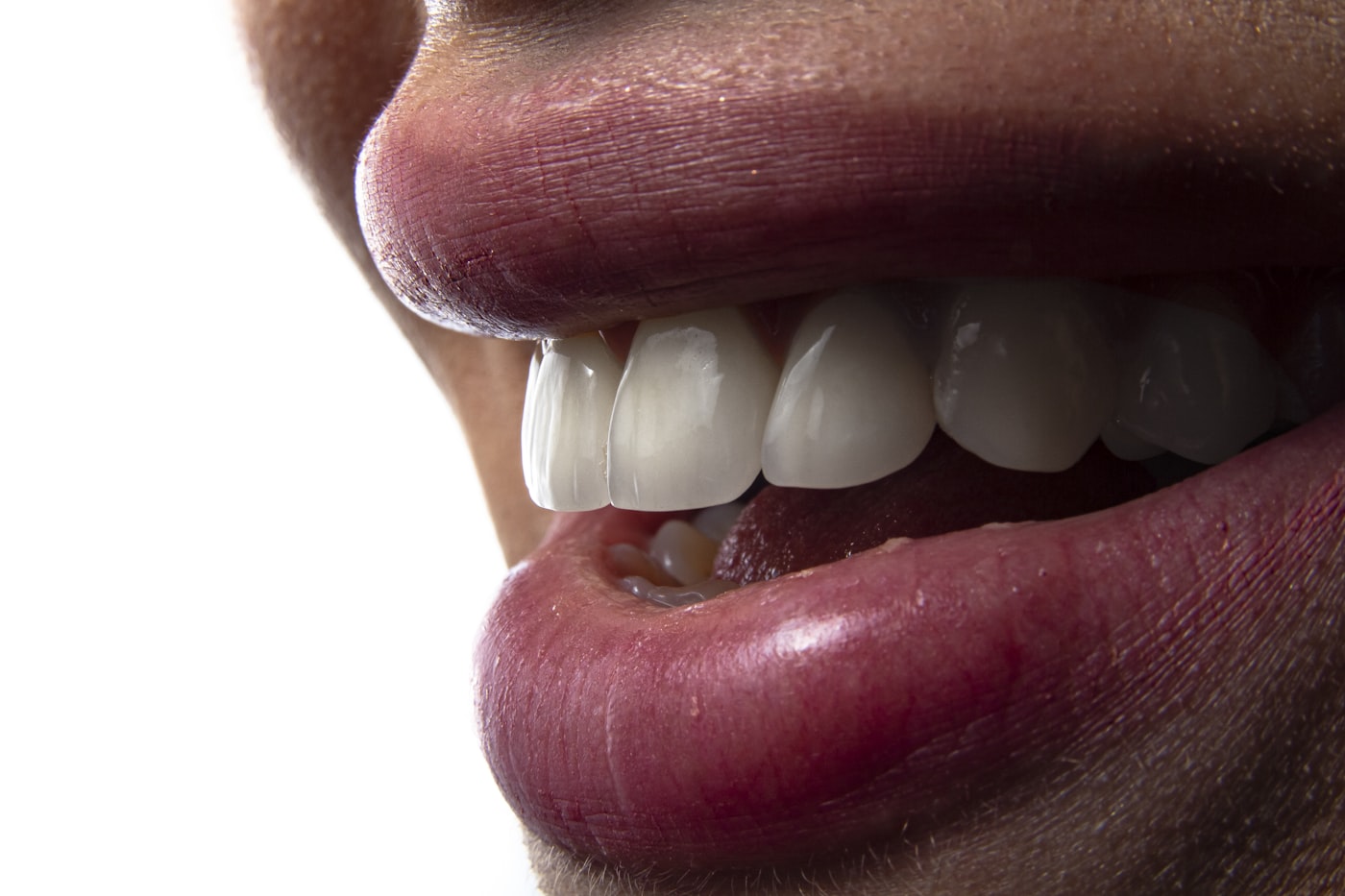 Facetas Dentárias